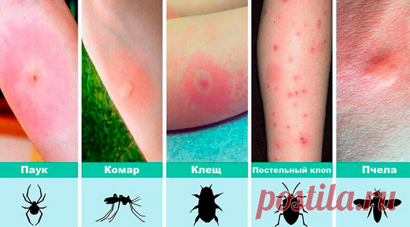 Укусы насекомых: 12 видов и что делать при каждом из них в домашних условиях + народные рецепты - Подружки - медиаплатформа МирТесен
