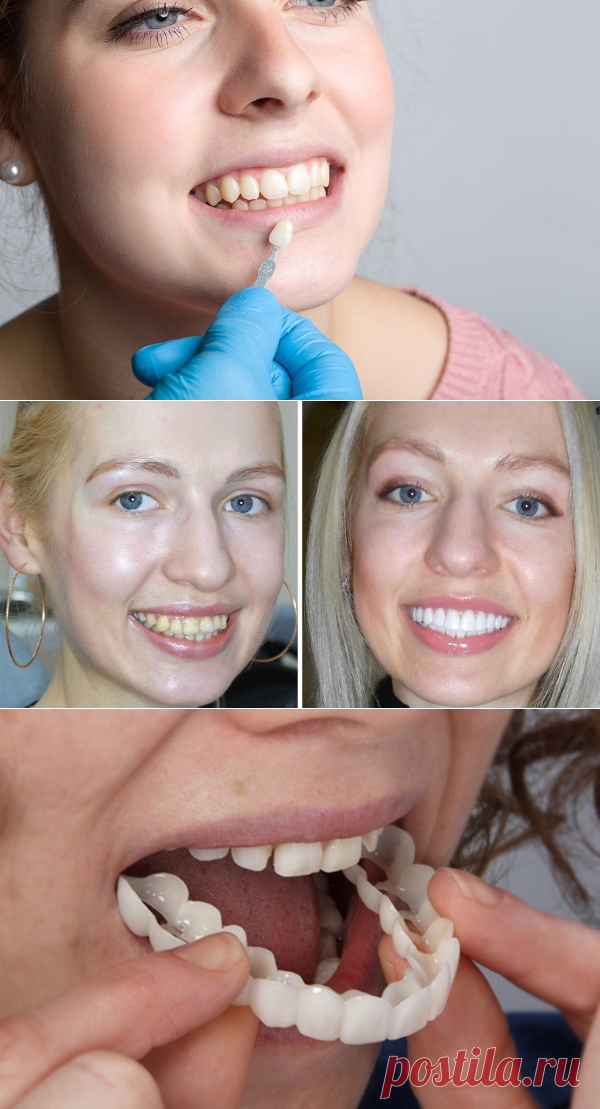 Процесс установки виниров. Виниры что такое как устанавливаются. Композитные виниры кариес. Керамические виниры емакс. Керамическое наращивание зуба.
