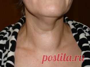 Лечение зоба народными средствами. - МирТесен