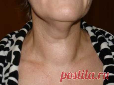 Лечение зоба народными средствами. - МирТесен