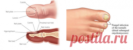 Профилактика и лечение грибка ногтей – эффективные народные и аптечные средства