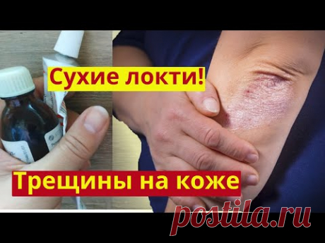 Сухие локти. Шершавые локти. Трескаются руки. Трескаются пятки. Заживляет и омолаживает. Рецепт мази