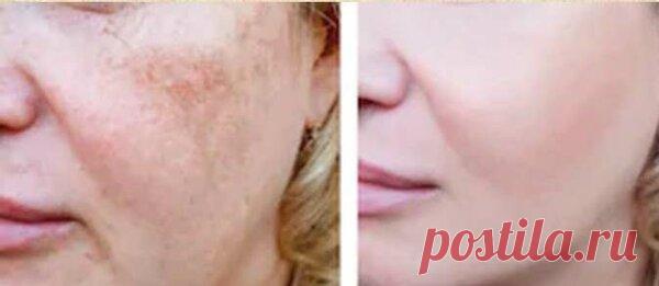 5 эффективных средств, уменьшающих гиперпигментацию кожи. Мой опыт удаления пигментации. | Советую - проверено | Яндекс Дзен