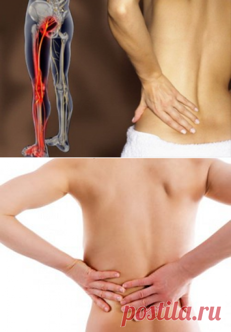 Ишиас и люмбаго: натуральные способы лечения