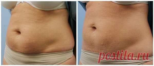 Мой самый лучший результат: избавилась от обвисшего живота за 15 процедур! Аптечное средство за 23 руб. | Домашняя Красота | Яндекс Дзен
