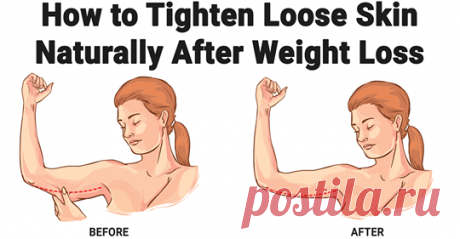 Как подтянуть кожу после похудения естественным способом - Упражнения и похудение Полезная информация Свободная кожа часто является побочным эффектом значительной потери веса и часто может быть обескураживающей. В то время как кожа никогда не сможет вернуться к своей первоначальной эластичности без хирургического вмешательства, существует множество естественных способов укрепления, тона и улучшения эластичности рыхлой кожи. Сбалансированная диета, ежедневные физические упр...
