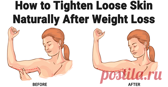 Как подтянуть кожу после похудения естественным способом - Упражнения и похудение Полезная информация Свободная кожа часто является побочным эффектом значительной потери веса и часто может быть обескураживающей. В то время как кожа никогда не сможет вернуться к своей первоначальной эластичности без хирургического вмешательства, существует множество естественных способов укрепления, тона и улучшения эластичности рыхлой кожи. Сбалансированная диета, ежедневные физические упр...