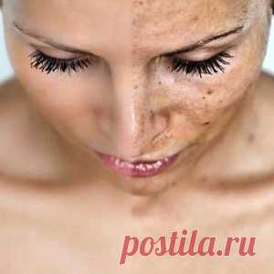 ВОЗРАСТНЫЕ ПЯТНА - ПРИЧИНЫ И СПОСОБЫ УСТРАНЕНИЯ. - МирТесен