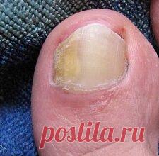 Чем лечить грибок ногтей на ногах: лучшие препараты и народные средства
ТОП 5 самых...

· Начальная стадия грибка ногтей на ногах не вызывает физического дискомфорта, изменения касаются внешнего вида ногтевой пластины. ... Внешние симптомы грибка не специфичны, они лишь указывают на поражение ногтей на ногах.