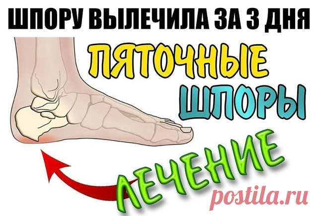 ШПОРУ ВЫЛЕЧИЛА ЗА 3 ДНЯ
Поделюсь рецептами от пяточных шпор. Прошлым летом на юге после ванн у меня так разболелась нога, что я не знала, куда ее деть. Пятка горела огнем. Приехав домой, побежала к хирургу. Молодая врач сделала снимок и объявила, что у меня после ванн обострилась пяточная шпора. Дала мне какую-то «памятку» - и все. Я поняла, что надо самой лечиться. Обратилась к народной медицине - стала искать рецепты от шпор. Все, что нашла, выписала и посылаю вам. Ведь ...