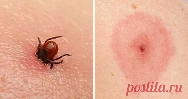 Эти насекомые могут быть опасны: каждый должен знать, как выглядят их укусы Близится лето, а вместе с ним и надоедливые насекомые, укусы которых нестерпимо чешутся и краснеют. Но сколько насекомых, столько и разных укусов. Поэтому важно знать, как выглядит тот или иной, чтобы оказать своевременную помощь себе или другому человеку...