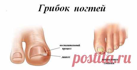 Реальные фото симптомов, как распознать грибок ногтей на ранней стадии. Правила лечения и три лучших препарата для быстрого избавления от онихомикоза.


Ноги &gt; Грибок &gt; Как выглядит грибок ногтей и чем его лечить? ... от инфекции кожи, например, после того, как она была занесена на пальцы рук или ног.