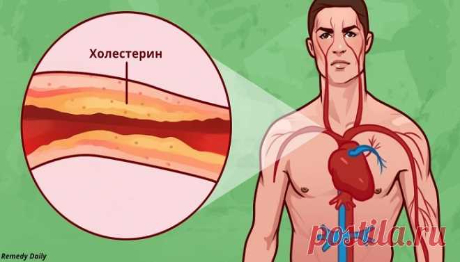 8 способов борьбы с холестерином и гипертонией — Сад Заготовка