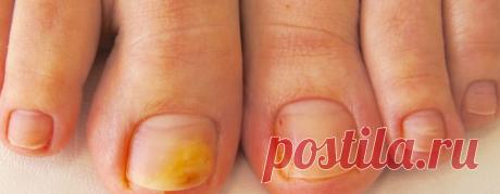 Грибок ногтей на ногах - симптомы и лечение (фото)

Грибок ногтей – достаточно распространенный недуг, при котором пластины становятся грубыми и ломкими, желтеют, покрываются мелкими трещинками. Заболевание протекает медленно, и в отсутствии адекватной терапии прогрессирует. Лечение онихомикоза в домашних условиях поможет устранить его