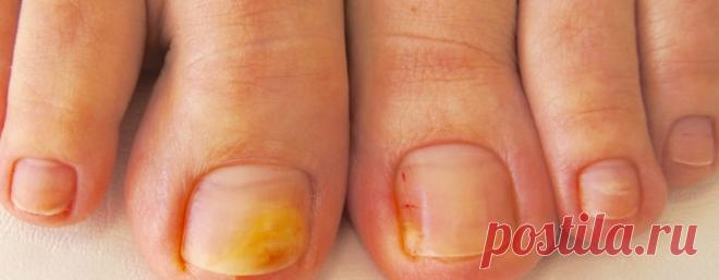 Грибок ногтей на ногах - симптомы и лечение (фото)

Грибок ногтей – достаточно распространенный недуг, при котором пластины становятся грубыми и ломкими, желтеют, покрываются мелкими трещинками. Заболевание протекает медленно, и в отсутствии адекватной терапии прогрессирует. Лечение онихомикоза в домашних условиях поможет устранить его