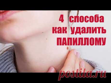 Делюсь опытом. КАК удалить папилломы в домашних условиях: 4 народных способа  ‪@dobrie_znania‬