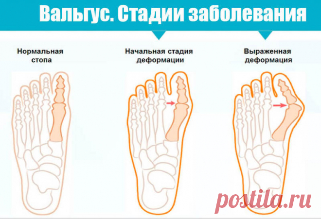 Вальгусная деформация стопы. Почему происходит Мы расскажем вам о наиболее частых причинах и симптомах вальгусной деформации стопы и предложим натуральные методы лечения и предупреждения этого заболевания…