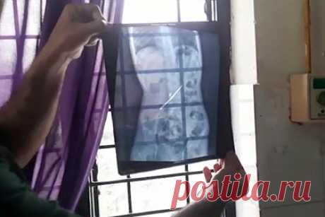 Юноша решил излечиться от любви поедать грязь и съел 16 зубных щеток и гвоздь. Подросток в Индии проглотил 16 зубных щеток и гвоздь длиной более семи сантиметров в надежде излечить пристрастие к поеданию грязи. Такой совет ему дал эксперт в области народной медицины. Ребенок испытал мучительную боль в животе и был госпитализирован. Врачи провели экстренную операцию и извлекли инородные предметы.