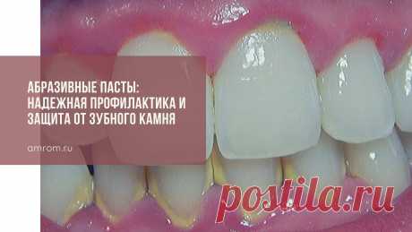 Абразивные пасты: надежная профилактика и защита от зубного камня | Журнал Амром Зубная паста от зубного камня. Согласно данным медицинской статистики, у 8 из 10 пациентов стоматологических кабинетов специалисты диагностируют клинические про