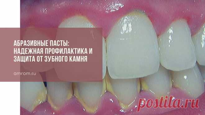 Абразивные пасты: надежная профилактика и защита от зубного камня | Журнал Амром Зубная паста от зубного камня. Согласно данным медицинской статистики, у 8 из 10 пациентов стоматологических кабинетов специалисты диагностируют клинические про