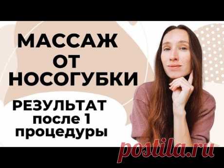 Удаление носогубных складок | Результат после 1-й процедуры!