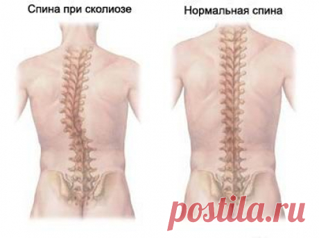 Сколиоз - виды и методы лечение сколиоза в Санкт-Петербурге