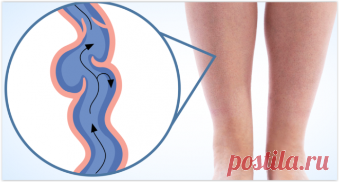 Лучшее упражнение и продукты от тромбоза и варикоза вен!