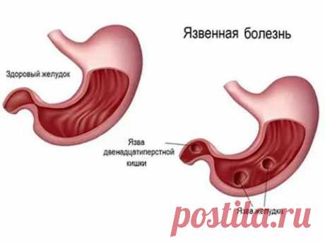 Бактерия хеликобактер пилори, что это такое и как лечить?