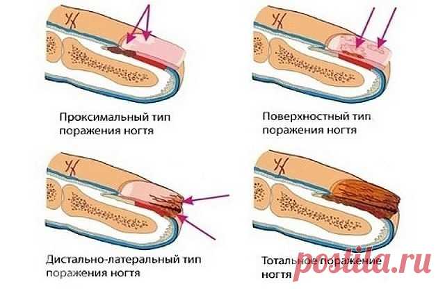 ЛУЧШЕЕ ДОМАШНЕЕ СРЕДСТВО ОТ ГРИБКА НОГТЕЙ, ВСЕГО ИЗ 2 ИНГРЕДИЕНТОВ!

Пожелтение
 и отслаивание ногтевой пластины, появление трещинок и зуд между 
пальцами — симптомы грибковой инфекции. Статистика свидетельствует, что 
каждый 5-й житель Земли страдает от этой проблемы.

Сниженный 
иммунитет, тесная обувь, излишняя потливость ног, лишний вес — факторы, 
способствующие заражению. Если вы заметили у себя на ногах проявления 
грибка, следует действовать незамедлительно!

Средс...