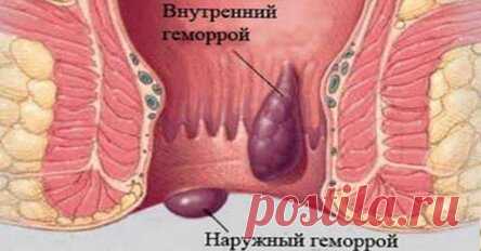 Она больше не боится ГЕМОРРОЯ! Смотри, 10 самых эффективных средств от свай.