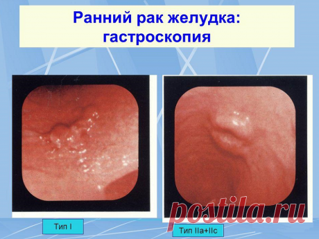 Признаки рака желудка. Ранняя стадия. Симптомы рака