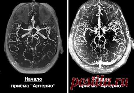 Признаки ангиодистонии сосудов головного мозга