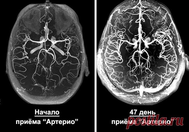Признаки ангиодистонии сосудов головного мозга