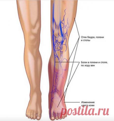 Как распознать варикоз и остановить болезнь на ранней стадии - Будь в форме! - медиаплатформа МирТесен Такое заболевание, как варикоз, не всегда проявляется в виде выступающих на голенях узлов, и если вовремя не заметить первоначальные признаки проблемы, то могут возникнуть серьезные осложнения. Согласно статистике этим заболеванием страдают около 10% мужчин и 30% женщин. Предлагаем