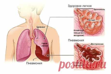 ЧУДО - РЕЦЕПТ ОТ ВОСПАЛЕНИЯ ЛЕГКИХ!

За этот рецепт нашу семью благодарили уже многие люди. К нам же он попал от одного доброго человека, когда болела наша мама. Состояние у нее было крайне тяжелое, никакого аппетита, дошло до того, что начала кашлять с кровью.

А спасло ее такое лекарство. Нужно взять по 0,5 кг несоленого сливочного масла, внутреннего смальца и меда, по 250 г алоэ и березовых почек, бутылку водки. Смешать масло, смалец, мед и водку. Измельченное алоэ и по...