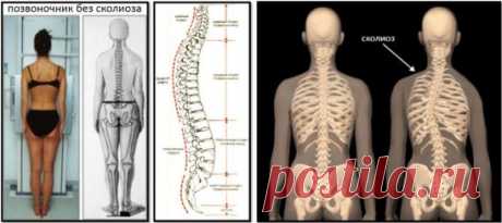 Проблема развития сколиоза 
Развитие сколиоза – это далеко не только проблема мышечных дисбалансов и смещения костей таза, стопы, позвоночника. Если рассматривать самую суть сколиоза, то становится ясно, что смещению костей и напряжению мышц должно было что-то предшествовать. Если тело развернуло кости таза ребенка, если развивается укорочение одной ноги, если присутствует разворот в верхнешейном отделе позвоночника и ответный разворот пятого поясничного позвонка и наоборо...