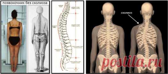 Проблема развития сколиоза 
Развитие сколиоза – это далеко не только проблема мышечных дисбалансов и смещения костей таза, стопы, позвоночника. Если рассматривать самую суть сколиоза, то становится ясно, что смещению костей и напряжению мышц должно было что-то предшествовать. Если тело развернуло кости таза ребенка, если развивается укорочение одной ноги, если присутствует разворот в верхнешейном отделе позвоночника и ответный разворот пятого поясничного позвонка и наоборо...