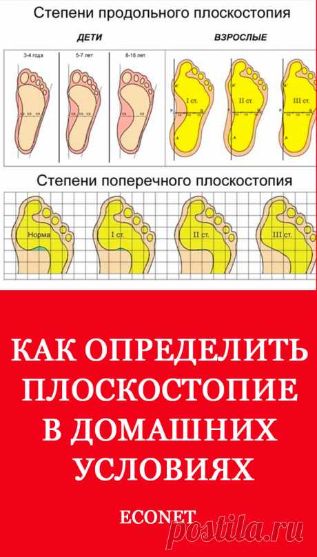 Как определить плоскостопие в домашних условиях

Деформирование стопы вызывает патологии позвоночника и приводит к болезненным осложнениям в коленях и тазобедренном суставе. Поэтому стоит узнать, как определить степень плоскостопия в домашних условиях, чтобы своевременно устранить заболевание на начальном этапе развития.