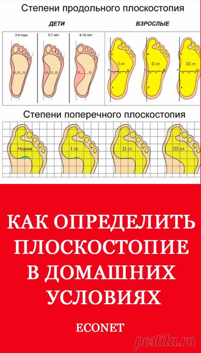 Как определить плоскостопие в домашних условиях

Деформирование стопы вызывает патологии позвоночника и приводит к болезненным осложнениям в коленях и тазобедренном суставе. Поэтому стоит узнать, как определить степень плоскостопия в домашних условиях, чтобы своевременно устранить заболевание на начальном этапе развития.
