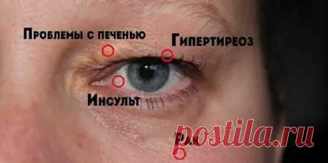 8 сигналов, при помощи которых глаза предупреждают о проблемах со здоровьем! Обрати внимание! Слепое пятноНебольшое слепое пятно в области видимого пространства может иметь глубокий смысл. Если ты видишь его с мерцающими огнями или волнистой линией, это может быть результатом мигрени. Появление слепых пятен может сопровождаться головной болью.Выпученные глазаЭто может быть связано с