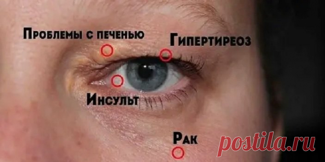 8 сигналов, при помощи которых глаза предупреждают о проблемах со здоровьем! Обрати внимание! Слепое пятноНебольшое слепое пятно в области видимого пространства может иметь глубокий смысл. Если ты видишь его с мерцающими огнями или волнистой линией, это может быть результатом мигрени. Появление слепых пятен может сопровождаться головной болью.Выпученные глазаЭто может быть связано с