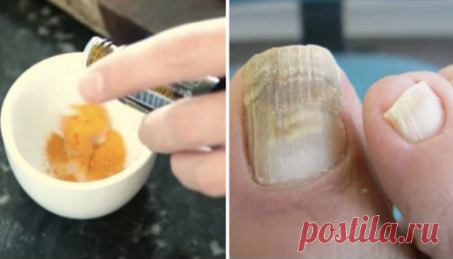 КАК ИЗБАВИТЬСЯ ОТ МИКОЗА НОГТЕЙ ЛЕГКО И БЫСТРО? ЭФФЕКТИВНЫЙ МЕТОД! — Планета и человек