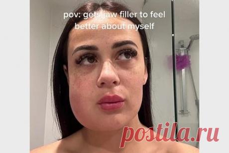 Девушка не смогла есть неделю из-за желания обрести идеальный подбородок. Жительница Австралии рассказала, что у нее было желание обрести идеальный подбородок, из-за которого она осталась с опухшей щекой. По словам блогерши Джоди, она мечтала скорректировать форму подбородка, сделав его контуры более четкими. Для этого девушка записалась на процедуру, на которой ей ввели филлеры в челюсть.