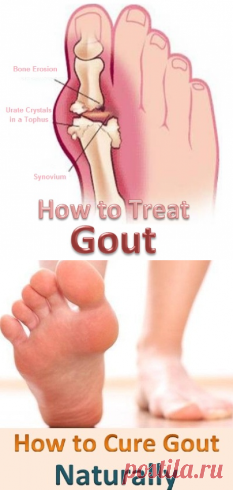 Home Remedies for Gout | Virtual Clinic