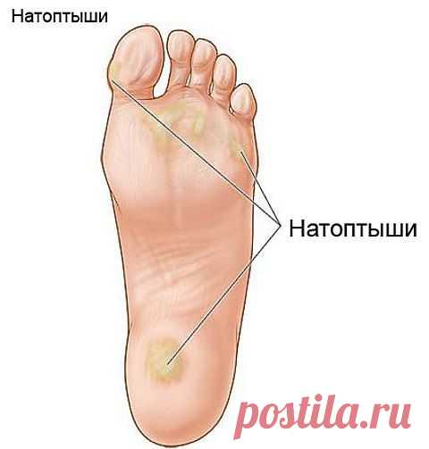 -Как избавиться от мозолей и натоптышей...