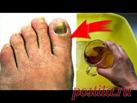 От этой СМЕСИ ГРИБОК исчезает. Мгновенный РЕЗУЛЬТАТ