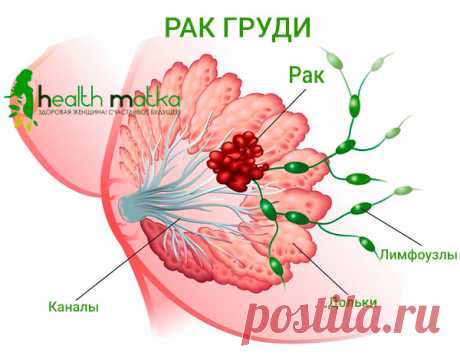 Рак груди: причины, диагностика, способы лечения