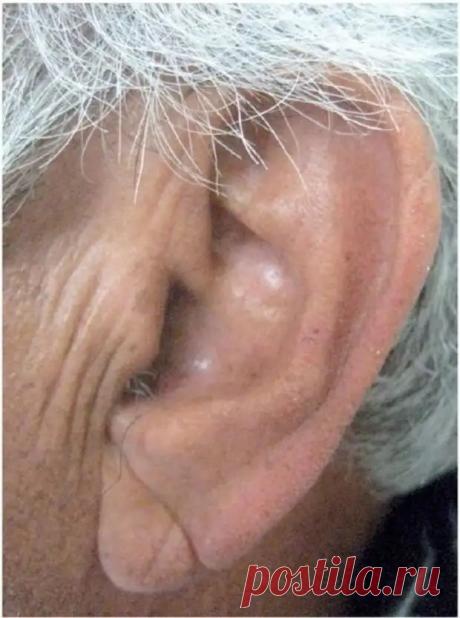 Симптом, который легко виден глазу и который говорит об атеросклерозе