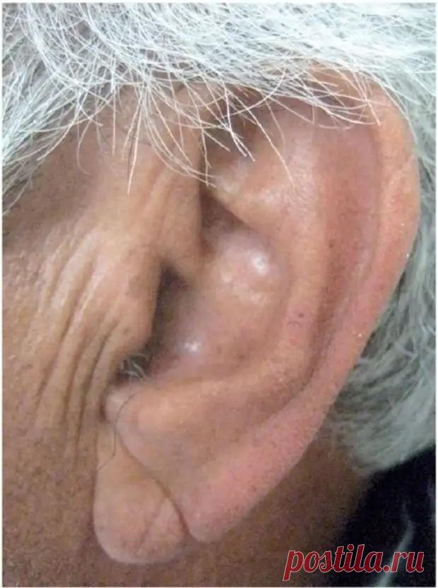 Симптом, который легко виден глазу и который говорит об атеросклерозе