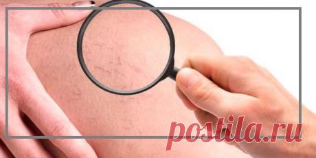 Простой способ: как убрать капиллярную сеточку на ногах и избавиться от отеков | моя записная книжка | Яндекс Дзен